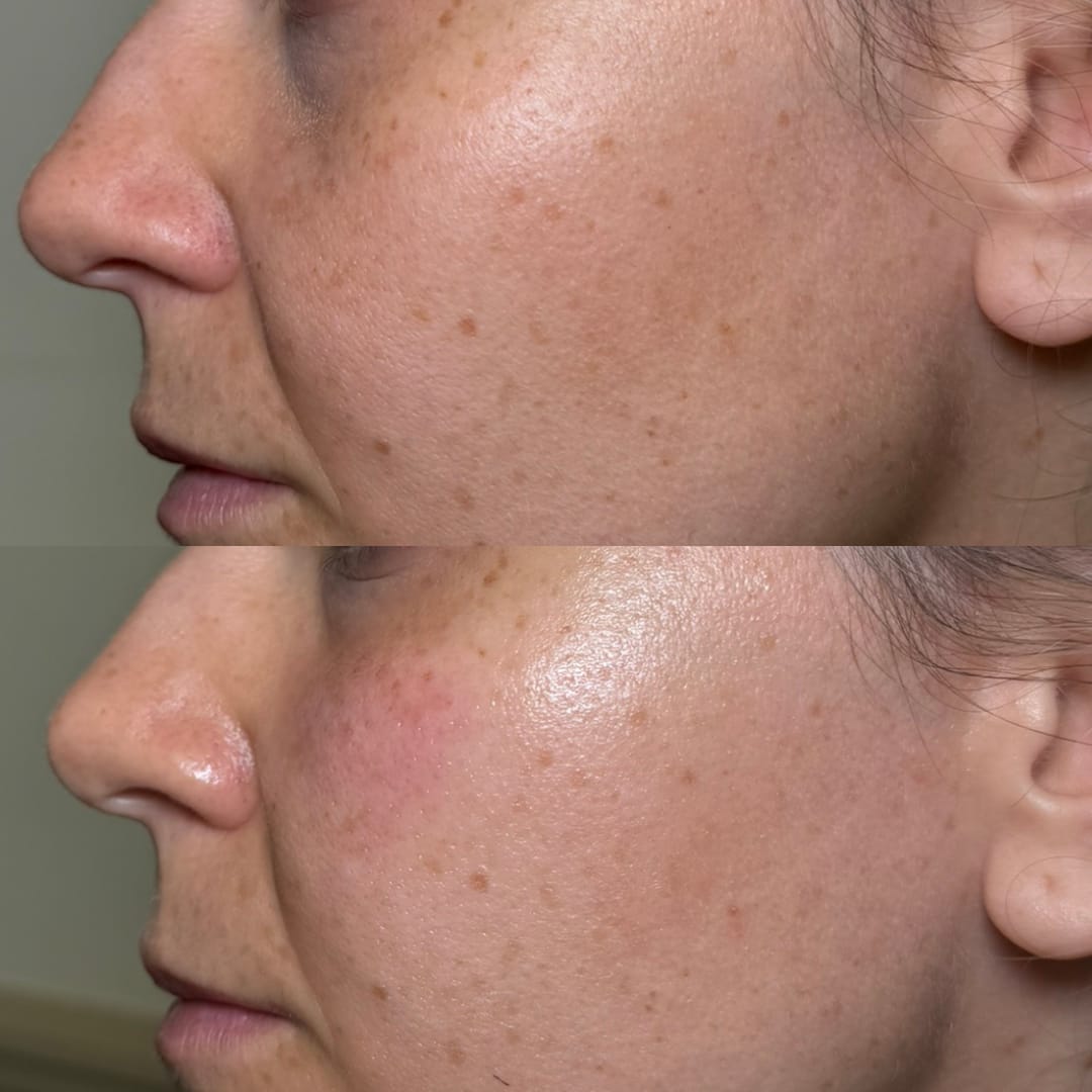 Mid Face Dermal Filler Before and After